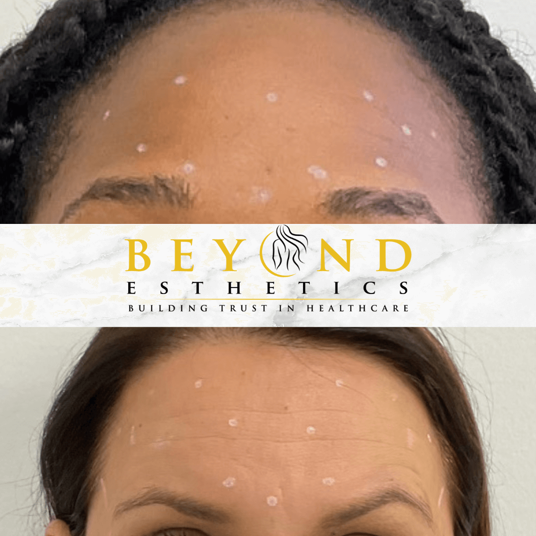 How much Botox do I need? Fore