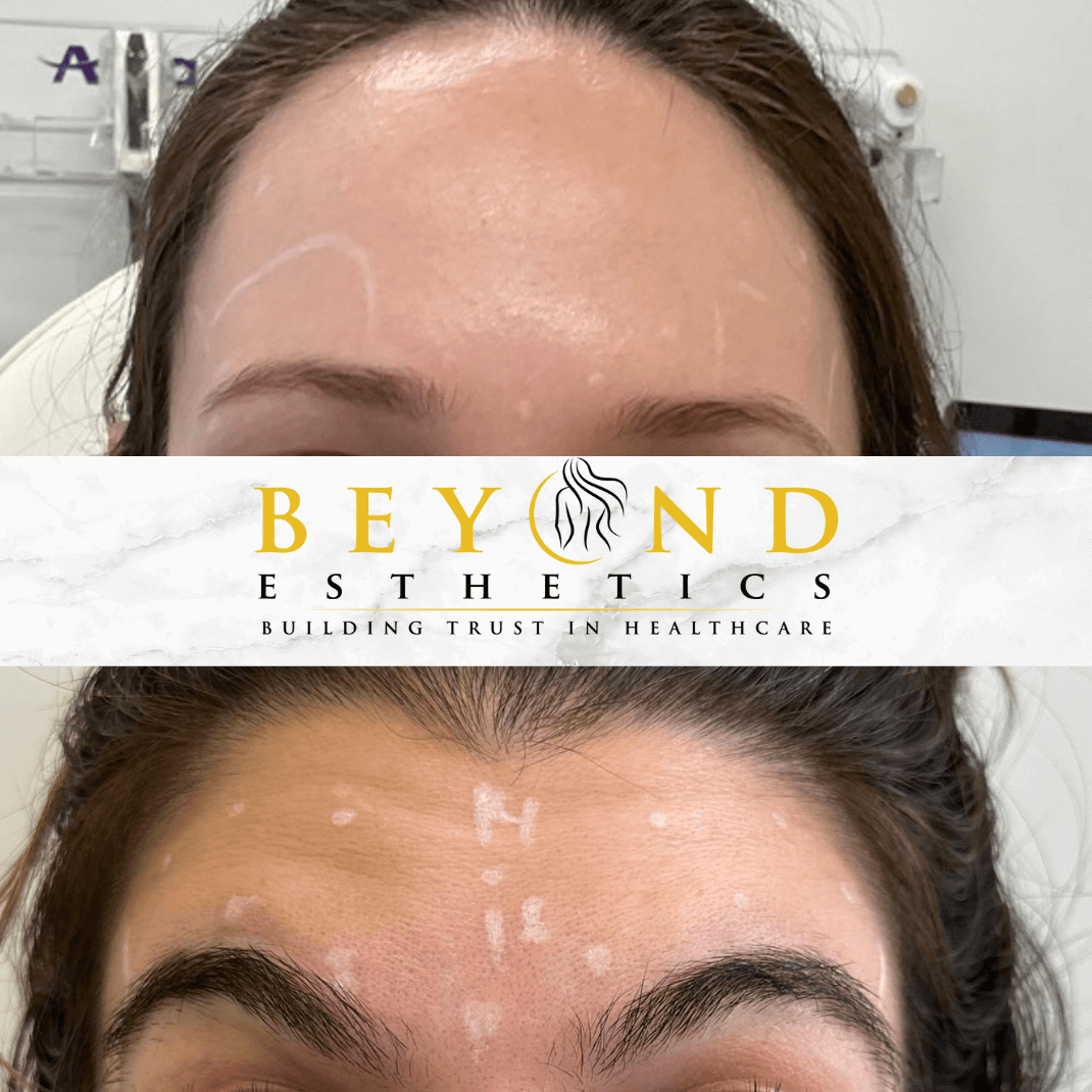 How much Botox do I need? Fore