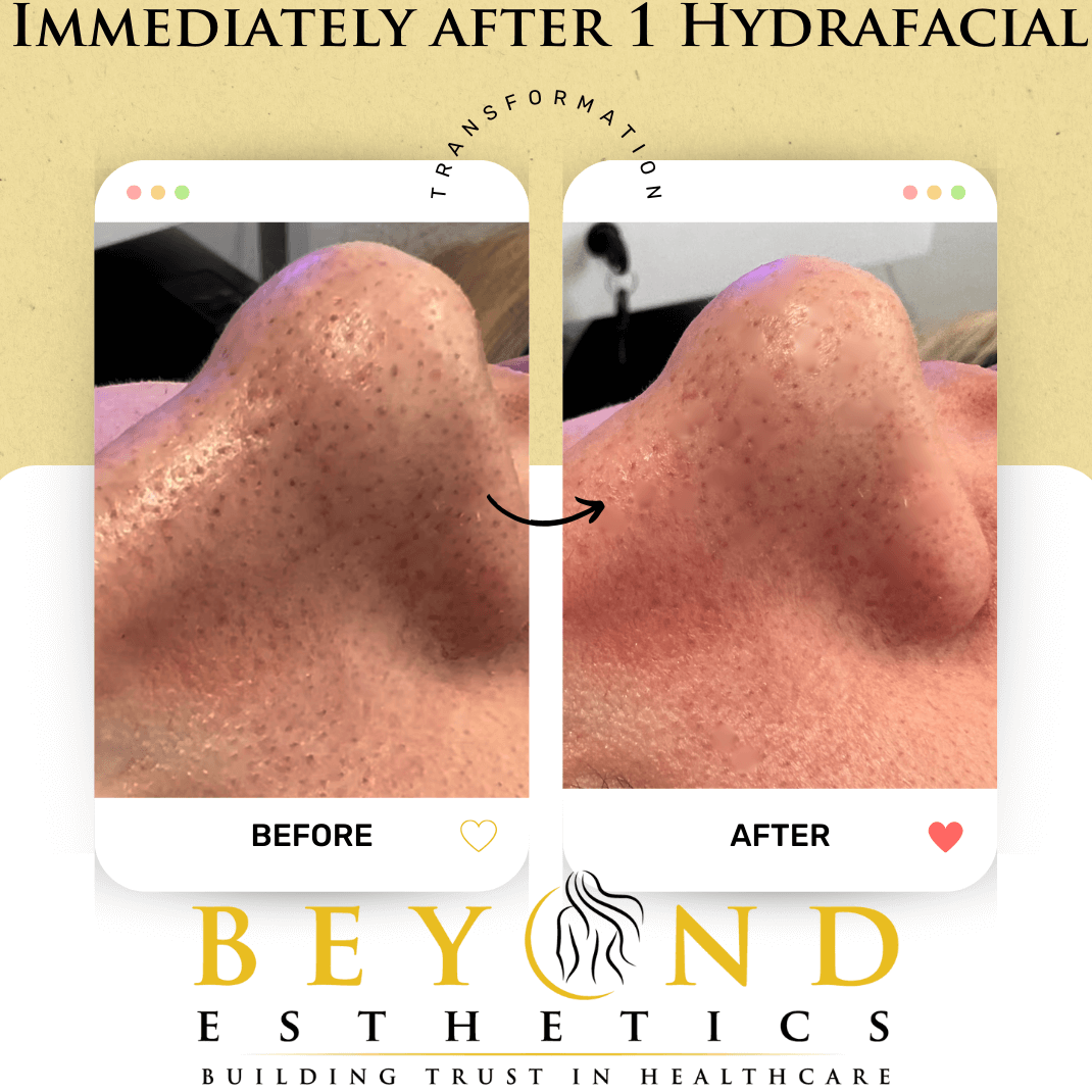 Can Hydrafacial help with acne