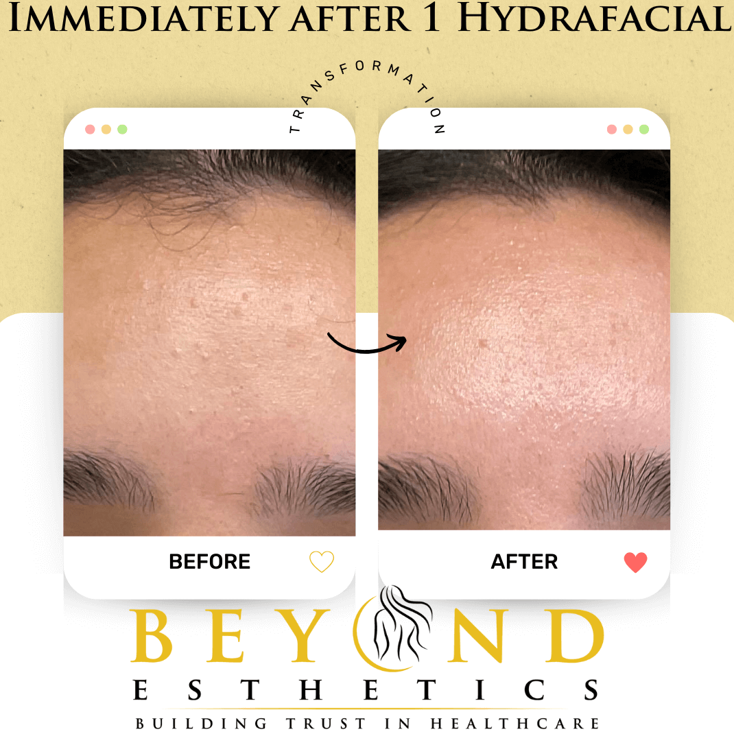 Can Hydrafacial help with acne