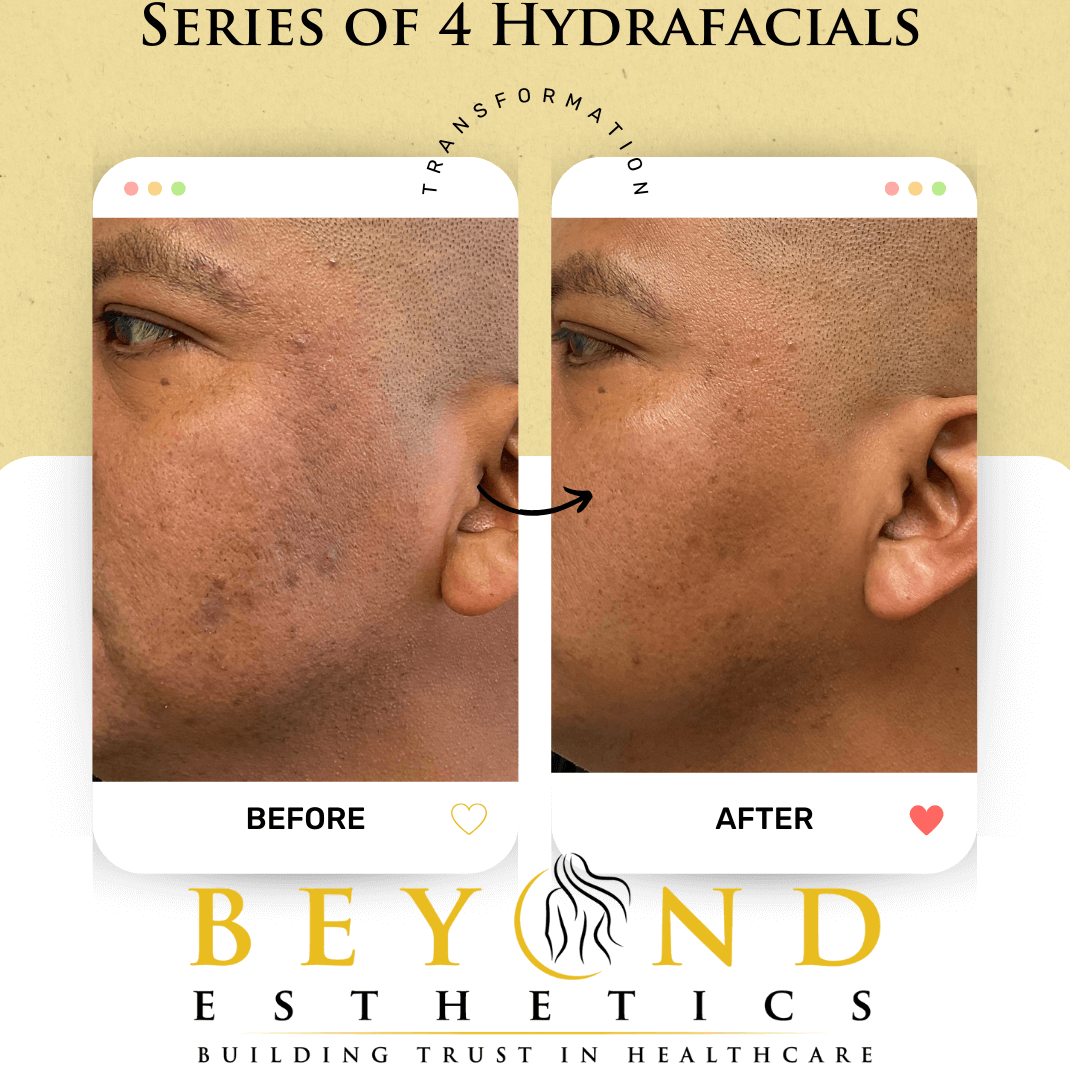 Can Hydrafacial help with acne