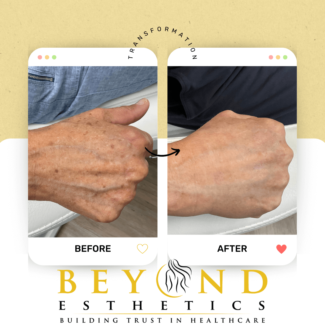 Benefits of IPL DYE-VL; anti-a