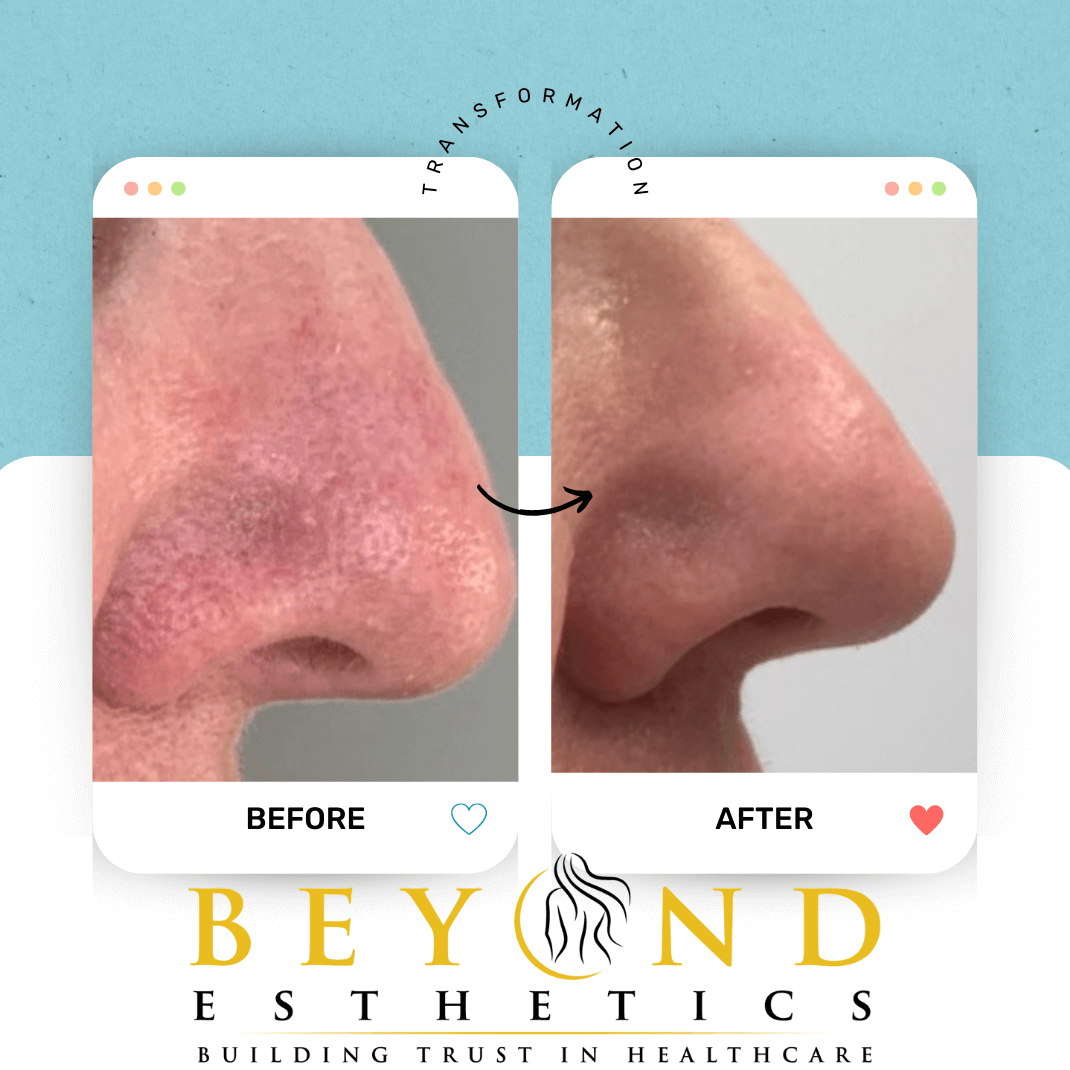 IPL DYE-VL Broken Capillary tr