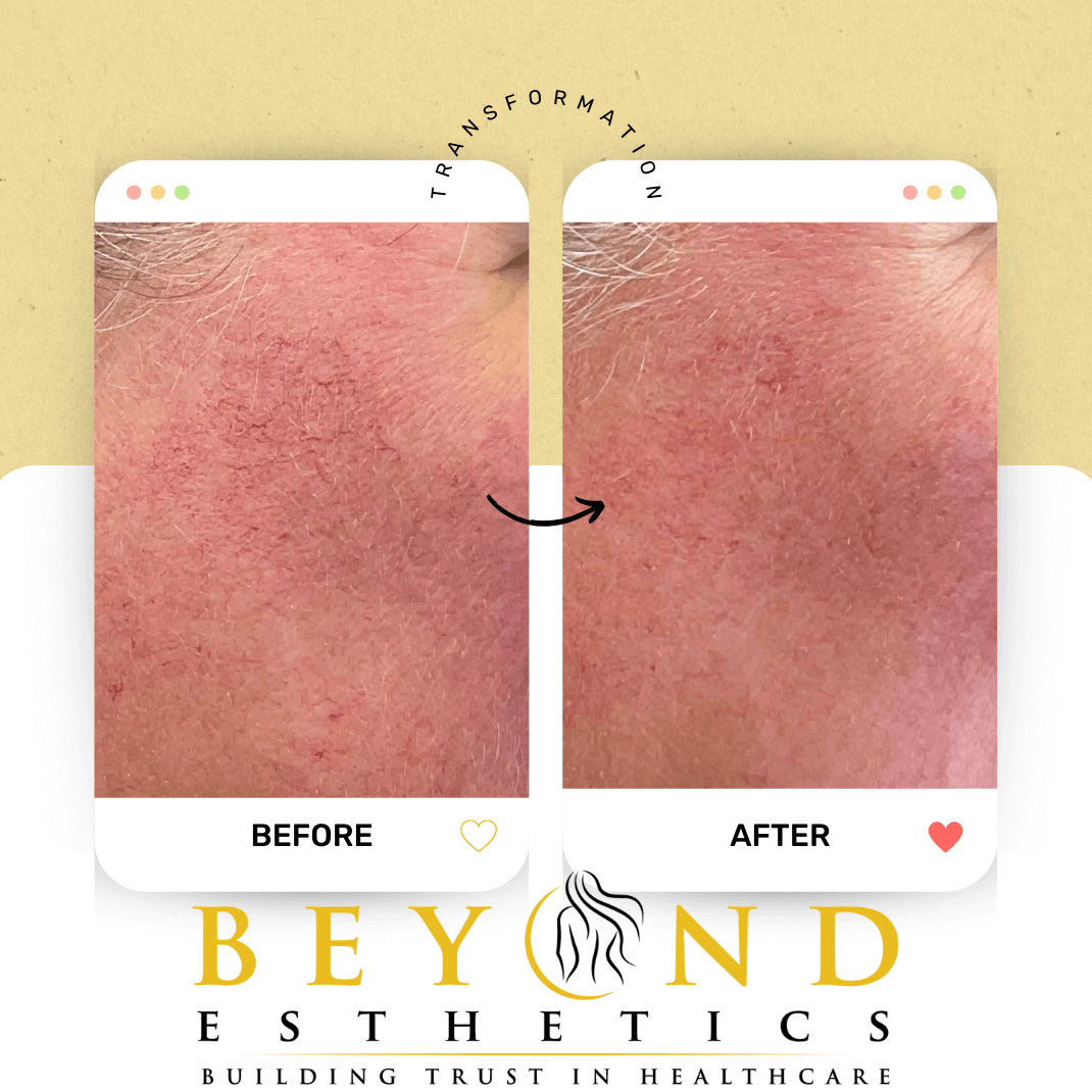 IPL DYE-VL Treatment of broken