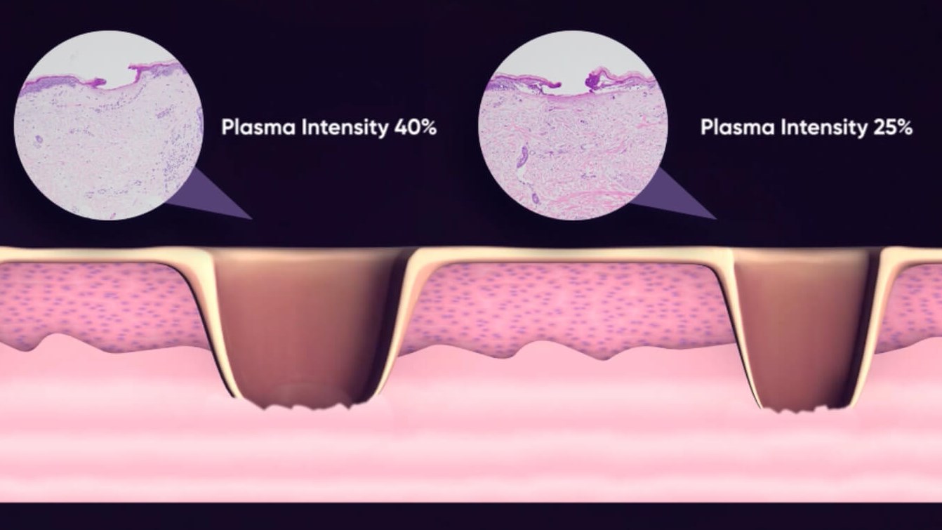 Opus Plasma, skin rejuvenation